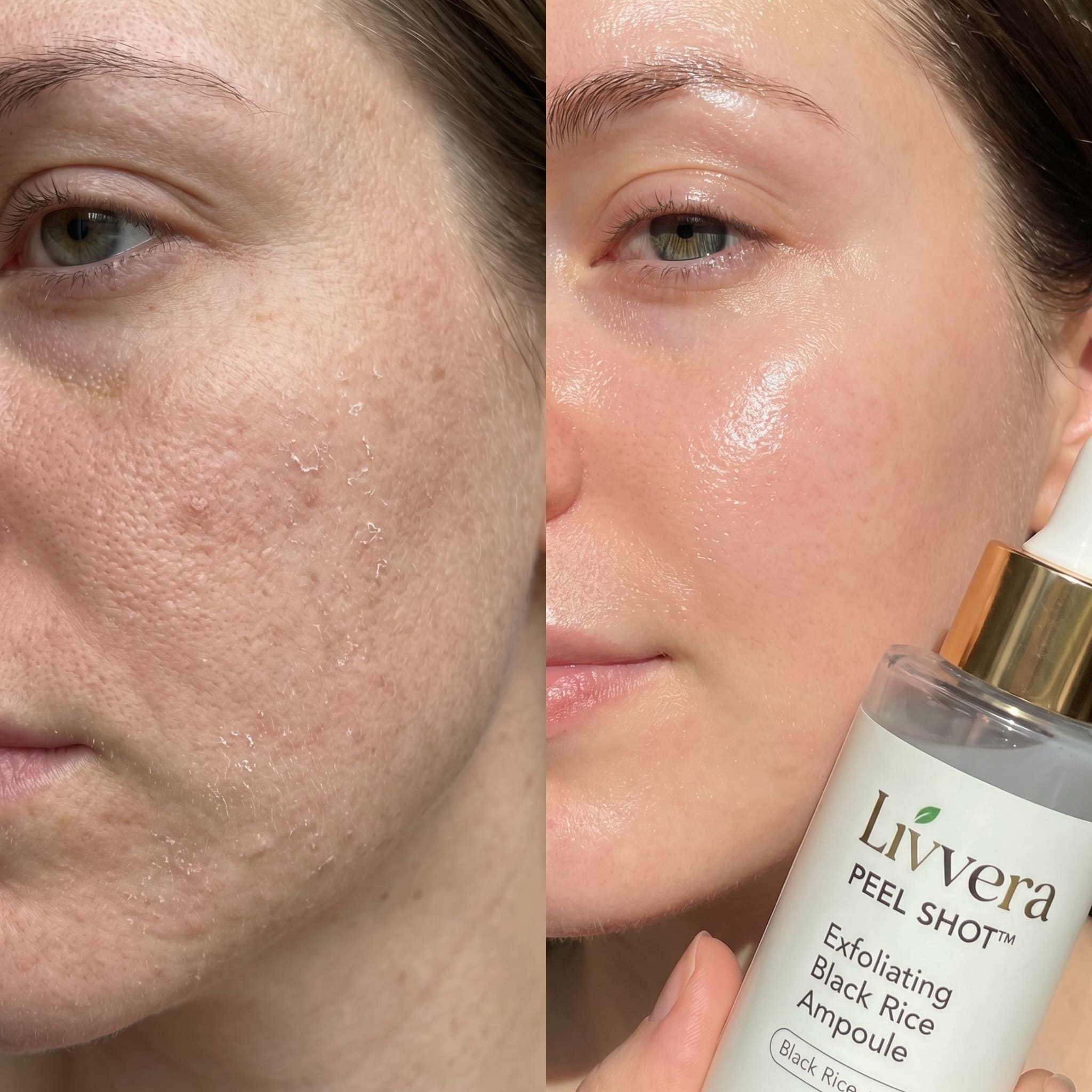Before and after comparison of a woman's face with Livvera Peel Shot Exfoliating Black Rice Ampoule.